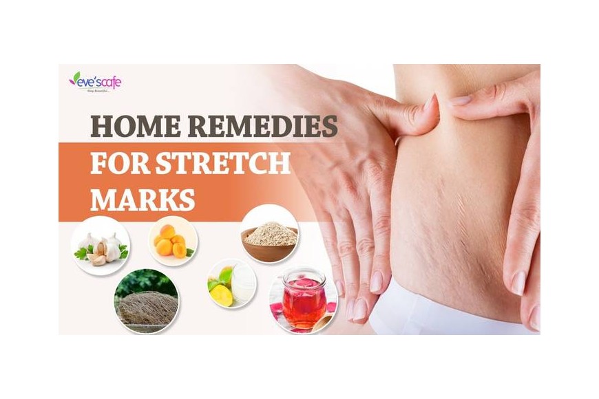 DIY – Home Remedies for Stretch Marks | Get Rid of Stretch Marks after Pregnancy