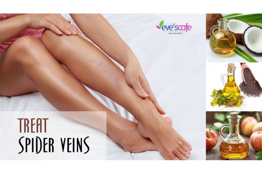 HOME REMEDIES FOR SPIDER VEINS | TREAT SPIDER VIENS @ HOME