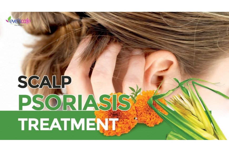 SCALP PSORIASIS OIL | CURE PSORIASIS QUICKLY